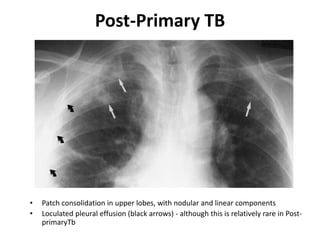 Post-Primary TB
• Patch consolidation in upper lobes, with nodular and linear components
• Loculated pleural effusion (bla...