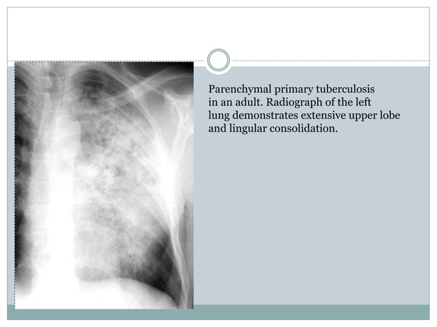 Role of Radiology in Pulmonary Tuberculosis | PPTX
