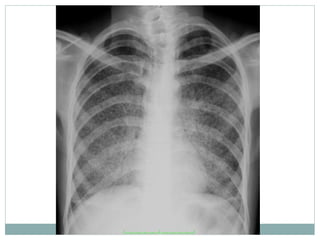 Role of Radiology in Pulmonary Tuberculosis | PPTX