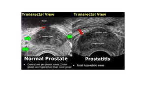 TB Prostate,Prostatitis,Prostate Abscess | PPTX