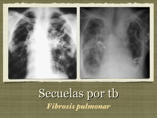 Secuelas por tb Fibrosis pulmonar 