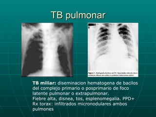 TB pulmonar TB miliar:  diseminacion hematogena de bacilos del complejo primario o posprimario de foco latente pulmonar o extrapulmonar. Fiebre alta, disnea, tos, esplenomegalia. PPD+ Rx torax: infiltrados micronodulares ambos pulmones 