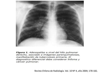 Revista Chilena de Radiología. Vol. 10 Nº 4, año 2004; 178-182.
 