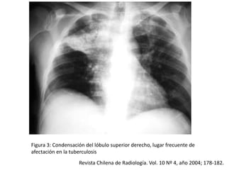 Figura 3: Condensación del lóbulo superior derecho, lugar frecuente de
afectación en la tuberculosis
                    Revista Chilena de Radiología. Vol. 10 Nº 4, año 2004; 178-182.
 