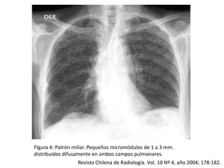 FIgura 4: Patrón miliar. Pequeños micromódulos de 1 a 3 mm.
distribuidos difusamente en ambos campos pulmonares.
                  Revista Chilena de Radiología. Vol. 10 Nº 4, año 2004; 178-182.
 