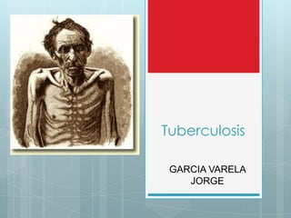 Tuberculosis

 GARCIA VARELA
    JORGE
 