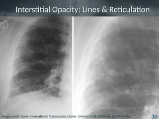 Typical Reticulation Line tb_radiology_basic_presentation_slides.pptx