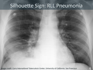 tb_radiology_basic_presentation_slides.pptx