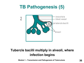 TB Pathogenesis (5) 
b r o n c h i o l e 
b l o o d v e s s e l 
t u b e r c l e b a c i l l i 
a l v e o l i 
2 
Tubercle bacilli multiply in alveoli, where 
infection begins 
Module 1 – Transmission and Pathogenesis of Tuberculosis 36 
 
