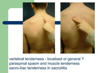 vertebral tenderness - localised or general ?
paraspinal spasm and muscle tenderness
sacro-iliac tenderness in sacroilitis
 