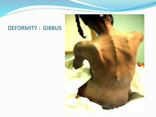 DEFORMITY : GIBBUS
 