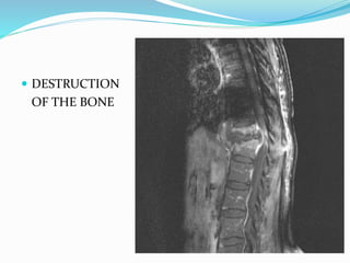  DESTRUCTION
OF THE BONE
 