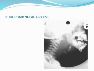 RETROPHARYNGEAL ABSCESS
 