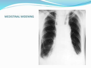 MEDISTINAL WIDENING
 