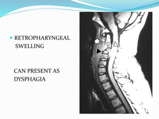  RETROPHARYNGEAL
SWELLING
CAN PRESENT AS
DYSPHAGIA
 
