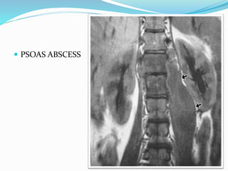  PSOAS ABSCESS
 
