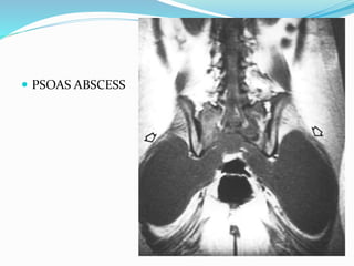  PSOAS ABSCESS
 