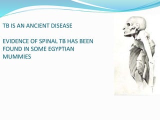 TB IS AN ANCIENT DISEASE
EVIDENCE OF SPINAL TB HAS BEEN
FOUND IN SOME EGYPTIAN
MUMMIES
 