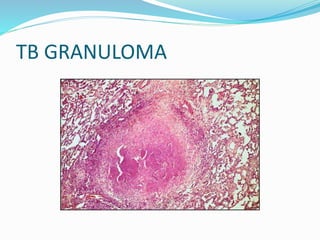 TB GRANULOMA
 