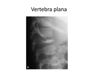 Vertebra plana
 