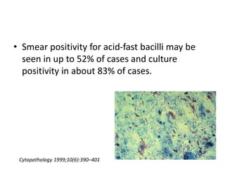 • Smear positivity for acid-fast bacilli may be
seen in up to 52% of cases and culture
positivity in about 83% of cases.
Cytopathology 1999;10(6):390–401
 