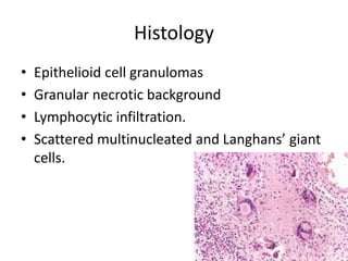 Histology
• Epithelioid cell granulomas
• Granular necrotic background
• Lymphocytic infiltration.
• Scattered multinucleated and Langhans’ giant
cells.
 