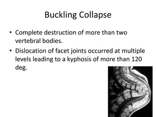 Buckling Collapse
• Complete destruction of more than two
vertebral bodies.
• Dislocation of facet joints occurred at multiple
levels leading to a kyphosis of more than 120
deg.
 