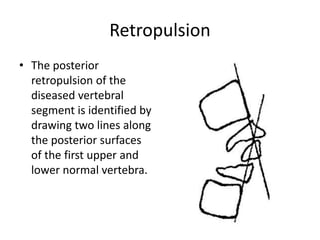 Retropulsion
• The posterior
retropulsion of the
diseased vertebral
segment is identified by
drawing two lines along
the posterior surfaces
of the first upper and
lower normal vertebra.
 