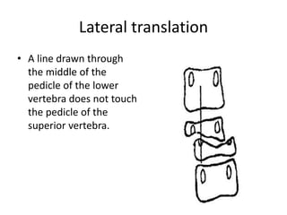Lateral translation
• A line drawn through
the middle of the
pedicle of the lower
vertebra does not touch
the pedicle of the
superior vertebra.
 