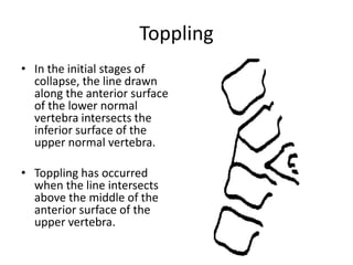 Toppling
• In the initial stages of
collapse, the line drawn
along the anterior surface
of the lower normal
vertebra intersects the
inferior surface of the
upper normal vertebra.
• Toppling has occurred
when the line intersects
above the middle of the
anterior surface of the
upper vertebra.
 