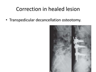 Correction in healed lesion
• Transpedicular decancellation osteotomy.
 