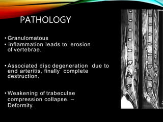 PATHOLOGY
• Granulomatous
• inflammation leads to erosion
of vertebrae.
• Associated disc degeneration due to
end arteritis, finally complete
destruction.
• Weakening of trabeculae
compression collapse. –
Deformity.
 