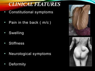 • Constitutional symptoms
• Pain in the back ( m/c )
• Swelling
• Stiffness
• Neurological symptoms
• Deformity
 