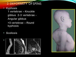 2. DEFORMITY OF SPINE:
• Kyphosis
1 vertebrae – Knuckle
gibbus 2-3 vertebrae -
Angular gibbus
>3 vertebrae – Round
kyphosis
• Scoliosis
• Lordosis
 