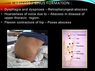 3. ABSCESS / SINUS FORMATION :
• Dysphagia and dyspnoea – Retropharyngeal abscess
• Hoarseness of voice due to – Abscess in disease of
upper thoracic region.
• Flexion contracture of hip – Psoas abscess
 