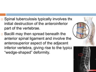  Spinal tuberculosis typically involves the
initial destruction of the anteroinferior
part of the vertebrae.
 Bacilli may then spread beneath the
anterior spinal ligament and involve the
anterosuperior aspect of the adjacent
inferior vertebra, giving rise to the typical
“wedge-shaped” deformity.
 