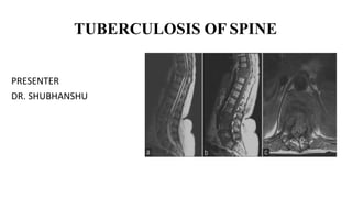 TUBERCULOSIS OF SPINE
PRESENTER
DR. SHUBHANSHU
 