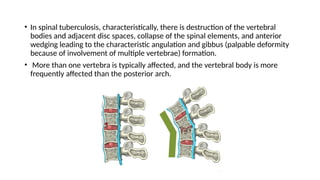TB spine.pptx23467899678888888899999000000 | PPTX