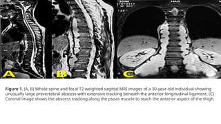 tuberculosis of spine.pptx by DR. Md. Emraan Hossain | PPTX