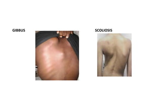 GIBBUS SCOLIOSIS
 