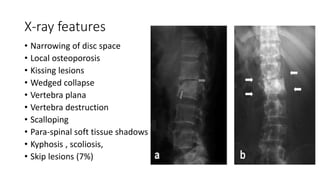X-ray features
• Narrowing of disc space
• Local osteoporosis
• Kissing lesions
• Wedged collapse
• Vertebra plana
• Vertebra destruction
• Scalloping
• Para-spinal soft tissue shadows
• Kyphosis , scoliosis,
• Skip lesions (7%)
 