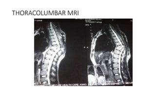 THORACOLUMBAR MRI
 