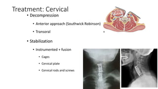 Treatment: Cervical
• Decompression
• Anterior approach (Southwick Robinson)
• Transoral
• Stabilization
• Instrumented + fusion
• Cages
• Cervical plate
• Cervical rods and screws
 