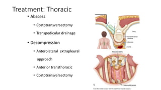 Treatment: Thoracic
• Abscess
• Costotransversectomy
• Transpedicular drainage
• Decompression
• Anterolateral extrapleural
approach
• Anterior transthoracic
• Costotransversectomy
 