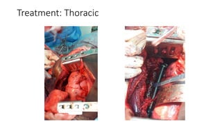 Treatment: Thoracic
 