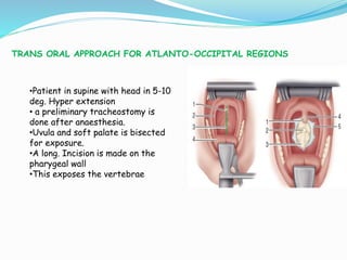 •Patient in supine with head in 5-10
deg. Hyper extension
• a preliminary tracheostomy is
done after anaesthesia.
•Uvula and soft palate is bisected
for exposure.
•A long. Incision is made on the
pharygeal wall
•This exposes the vertebrae
TRANS ORAL APPROACH FOR ATLANTO-OCCIPITAL REGIONS
 