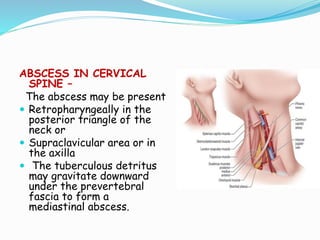 ABSCESS IN CERVICAL
SPINE –
The abscess may be present
 Retropharyngeally in the
posterior triangle of the
neck or
 Supraclavicular area or in
the axilla
 The tuberculous detritus
may gravitate downward
under the prevertebral
fascia to form a
mediastinal abscess.
 