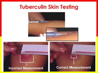 Tuberculin Skin Testing  