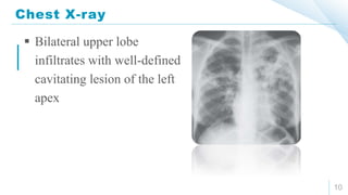 Chest X-ray
10
 Bilateral upper lobe
infiltrates with well-defined
cavitating lesion of the left
apex
 