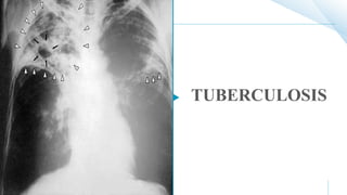 TUBERCULOSIS
 
